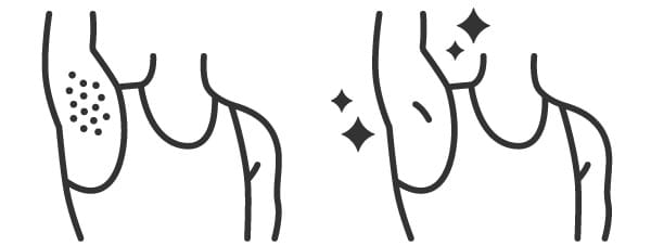 ワキ脱毛をする