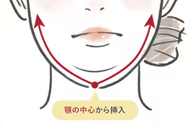 顎下すっきリフト