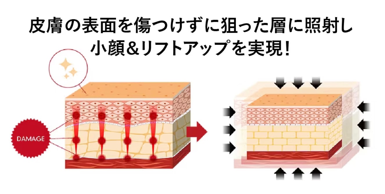 たるみ治療といえばHIFUと聞くけど、何が良いのか