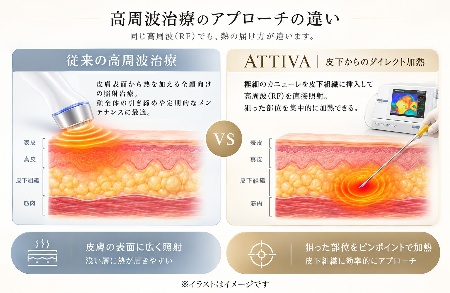肌内部から高周波を当てられる最新治療