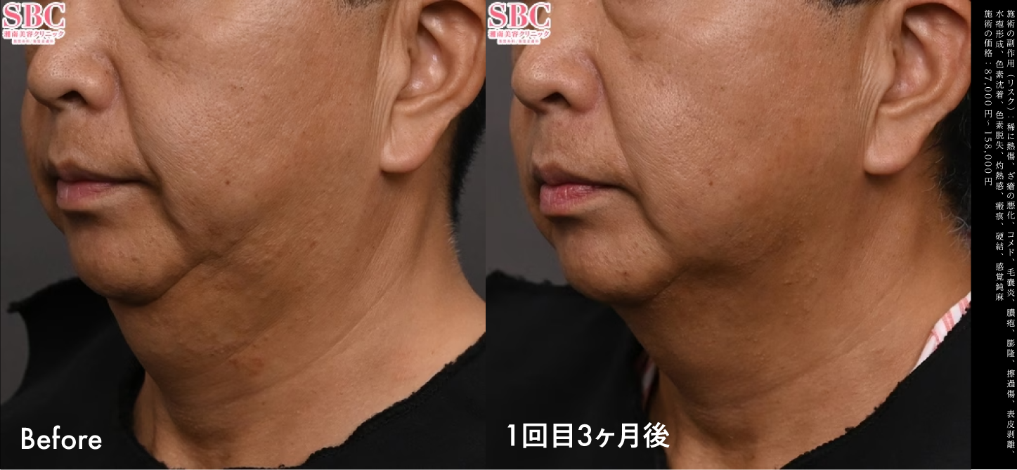 アゴ下