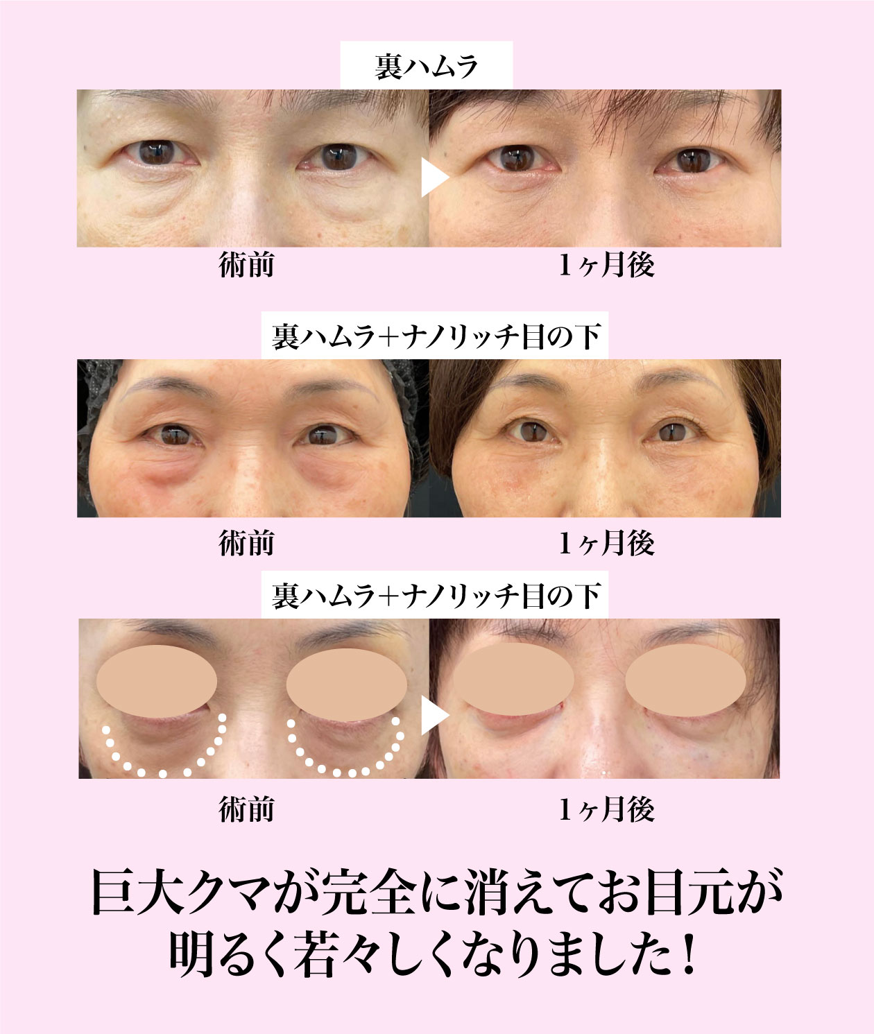裏ハムラ法