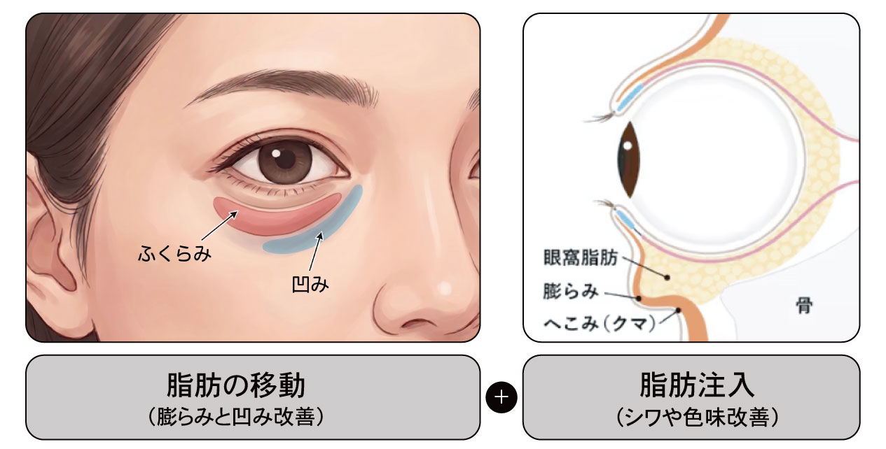 脂肪注入へのこだわり