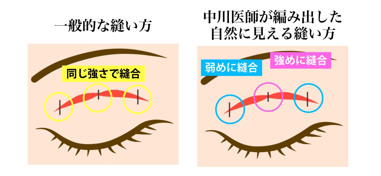 中川医師がこだわり抜いて編み出した独自の縫合技術
