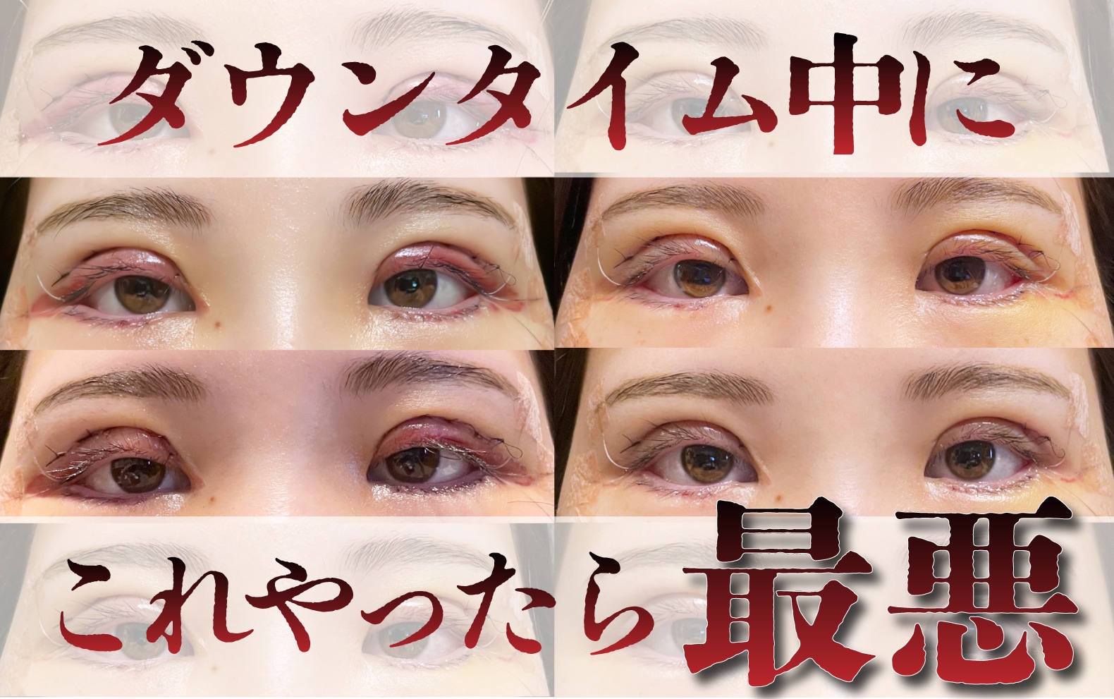 全切開二重術後にやってはいけないこと3選！ダウンタイムの過ごし方を解説！