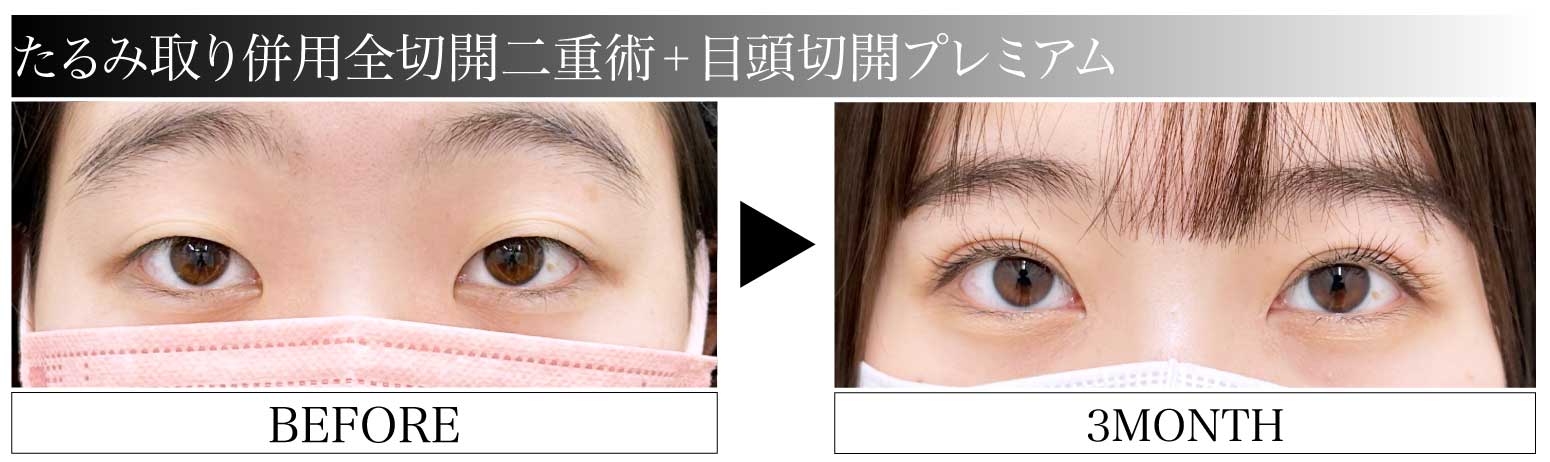 たるみ取り併用全切開二重術×目頭切開