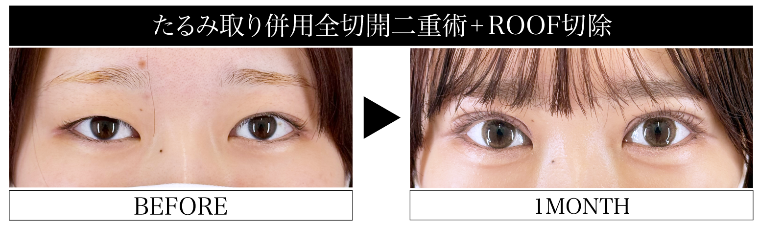 たるみ取り併用全切開二重術×ROOF切除