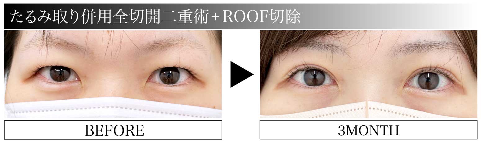 たるみ取り併用全切開二重術×ROOF切除