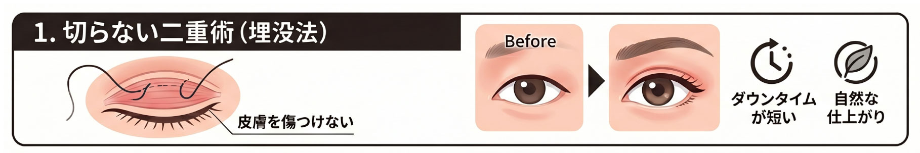 切らない二重術（埋没法）