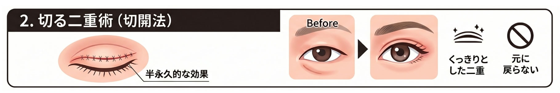 切る二重術（切開法）