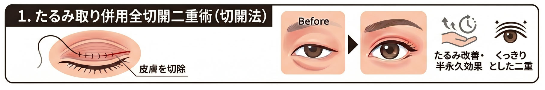 1位 たるみ取り併用全切開二重術