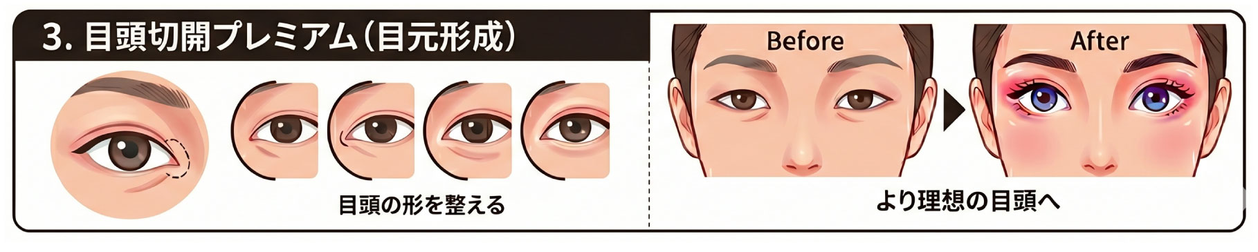 3位 目頭切開プレミアム