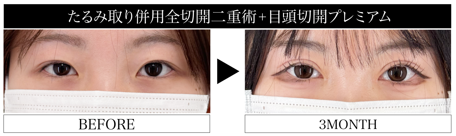 たるみ取り併用全切開二重術×目頭切開