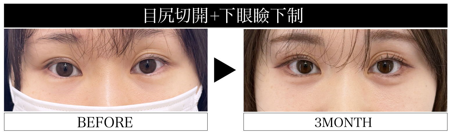 目尻切開×下眼瞼下制法