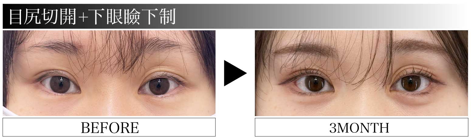 目尻切開×下眼瞼下制法