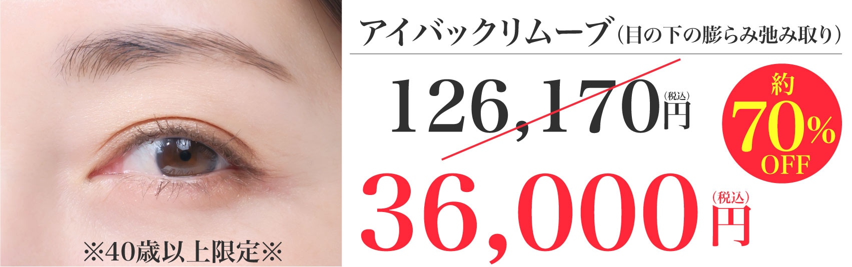 目の下の膨らみ弛み取り