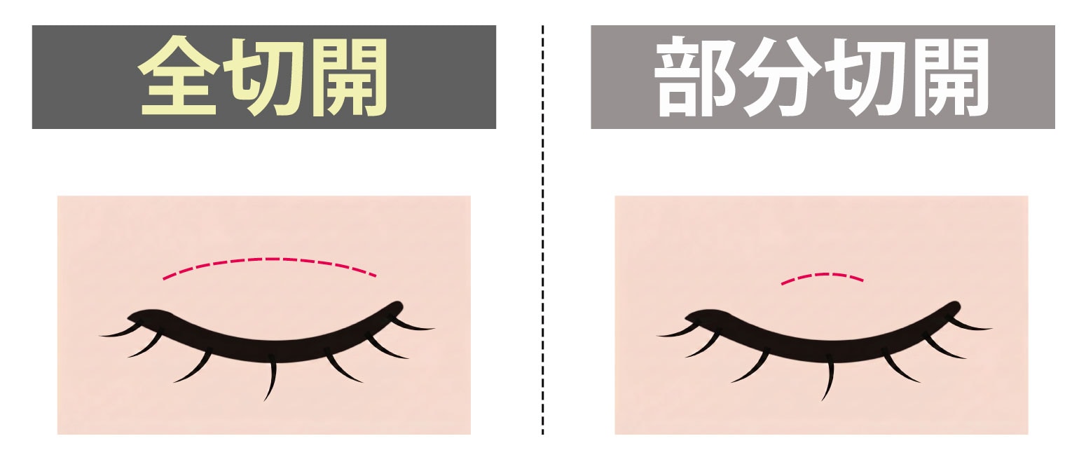 神戸三宮院が「全切開二重術」にこだわる理由｜部分切開との違いとメリット