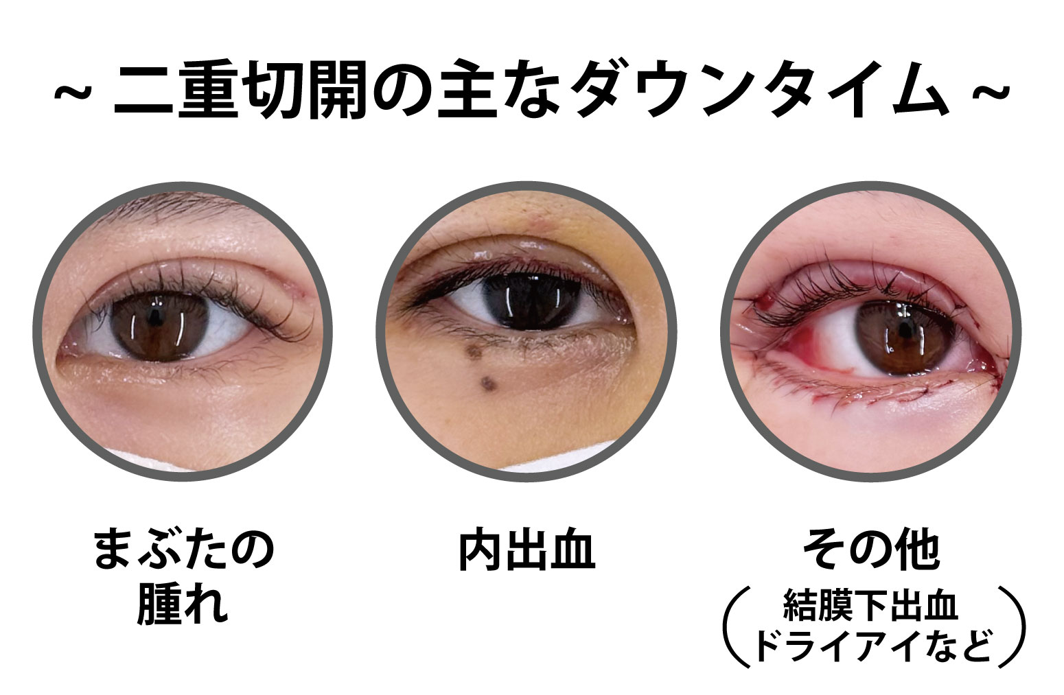 ダウンタイムの期間や症状について