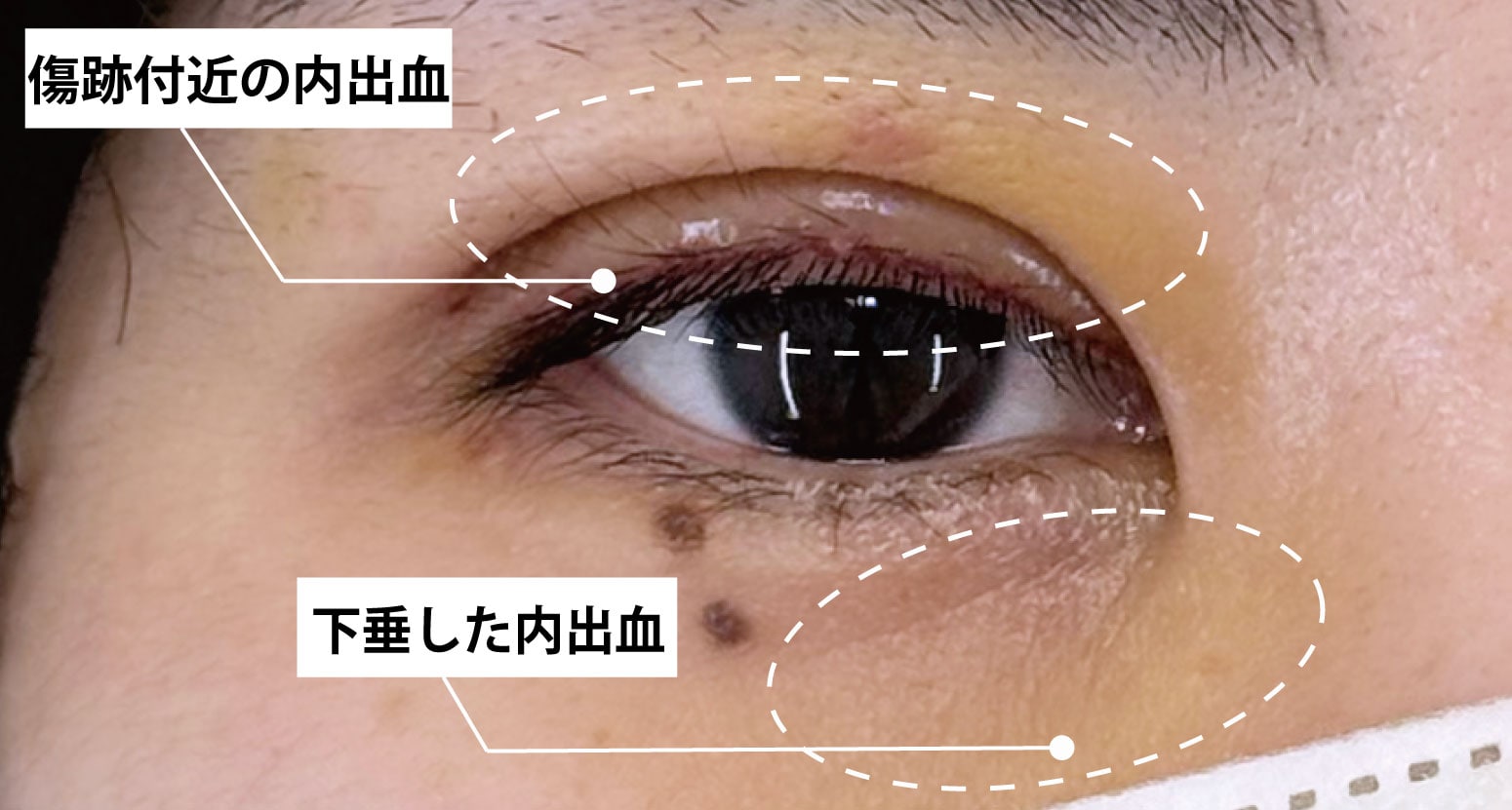 ②内出血