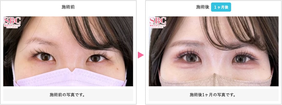 二重術全切開 症例写真