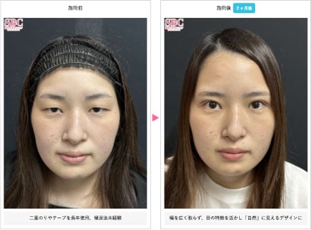 二重術全切開＋ROOF切除 症例写真