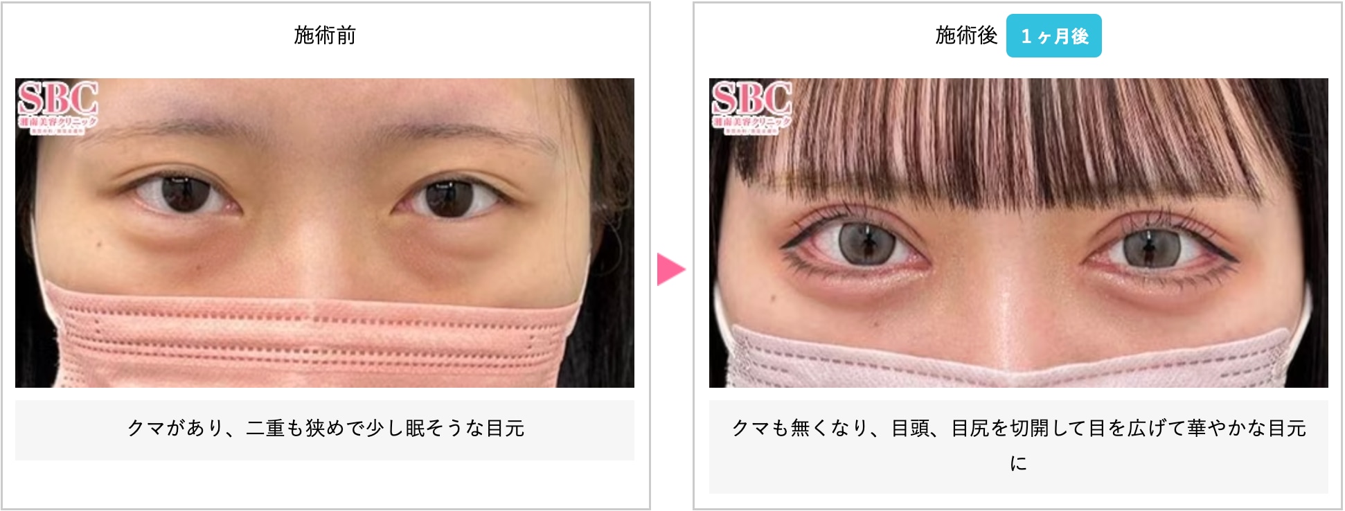 二重術全切開＋目頭切開＋目尻切開 症例写真