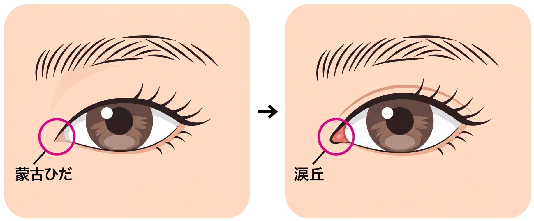 目頭切開とは？効果とメリット