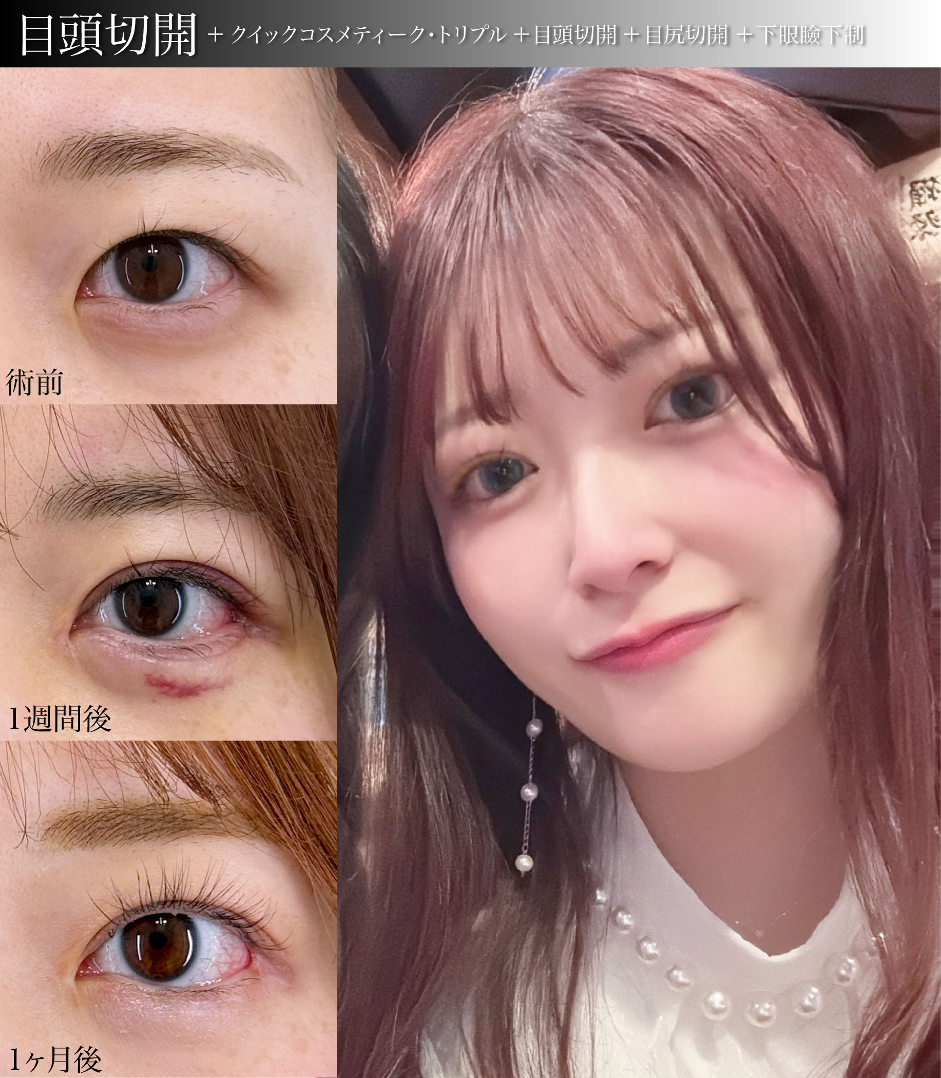 目頭切開プレミアム+クイックコスメティーク・トリプル+目尻切開+下眼瞼下制