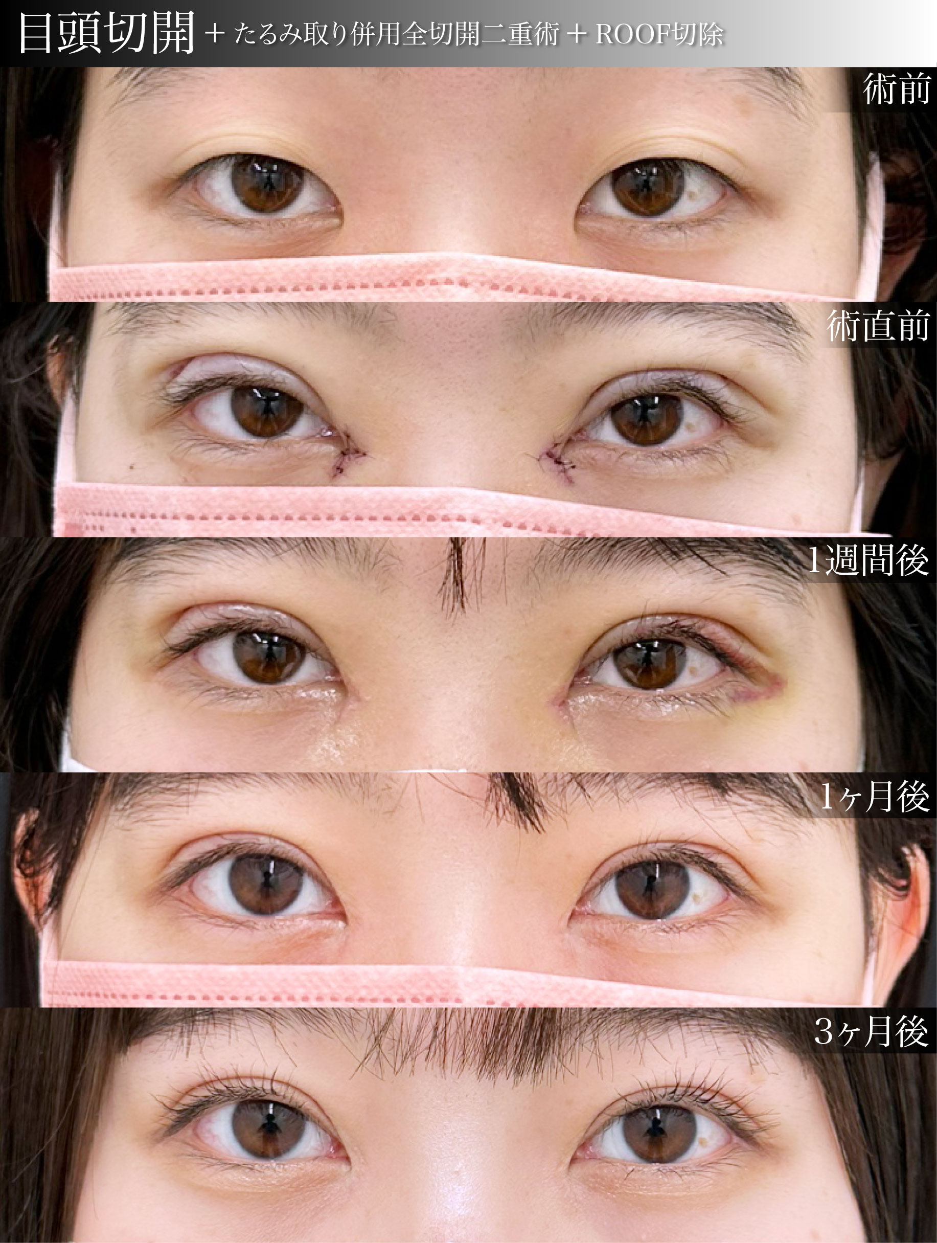 目頭切開プレミアム+たるみ取り併用全切開二重術+ROOF切除