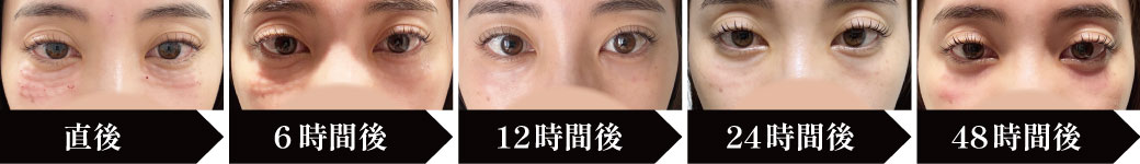 直後〜48時間後までをまとめました