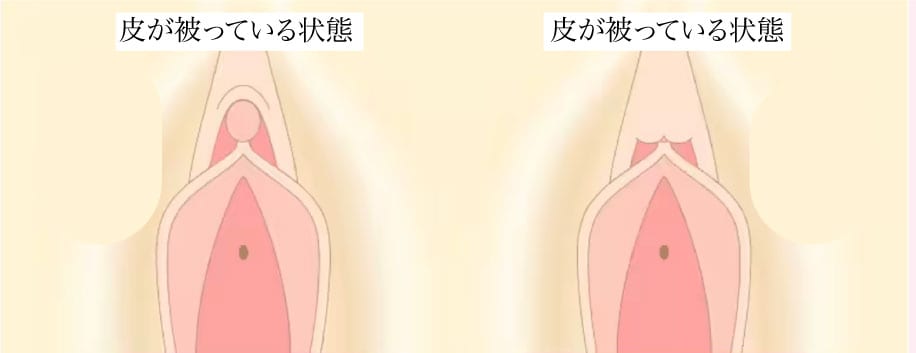 よく聞く「包茎」男性だけじゃないんです！！