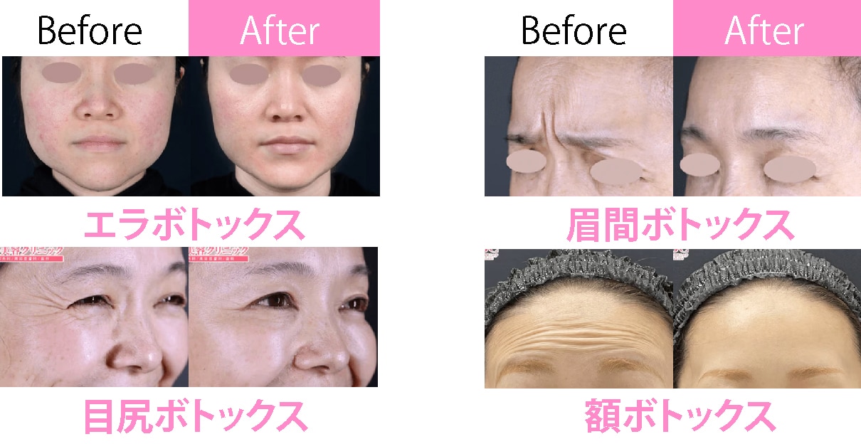 ボトックス　症例写真