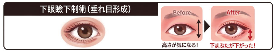 下眼瞼下制（グラマラスライン）で縦幅を広げる仕組み