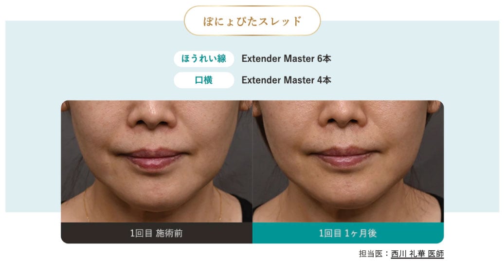 ぽにょぴたスレッドってなに？