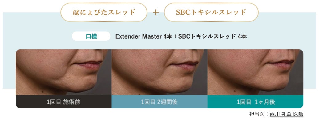 SBCトキシルスレッドとの併用で表情ジワ・口角ケア