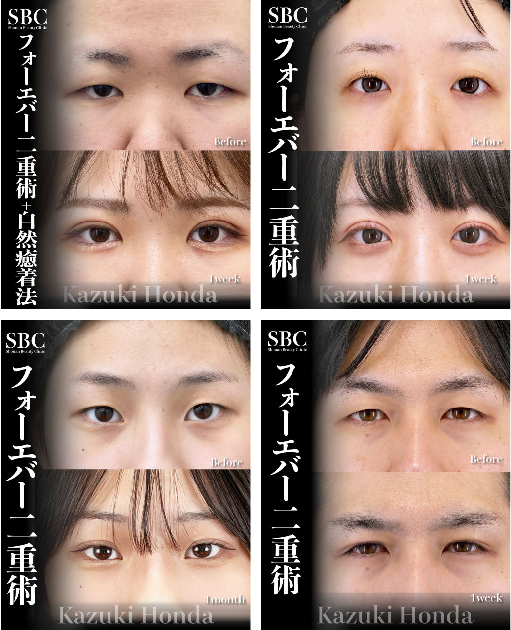 埋没二重術の症例集