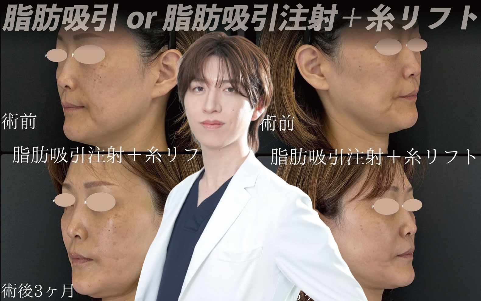 【神戸三宮院】本田一樹医師が提案！脂肪減少×引き上げで作る「究極の小顔への方程式」