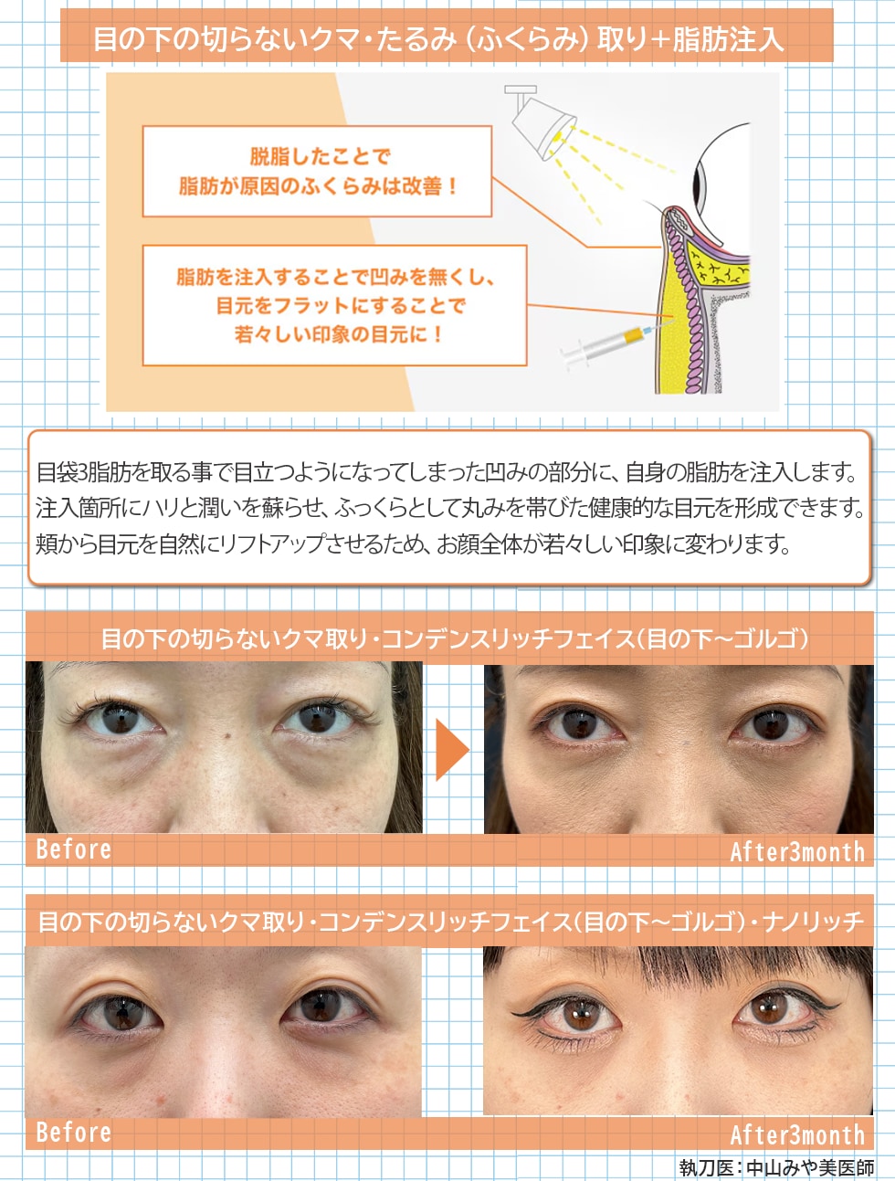 目の下の切らないクマ・たるみ(ふくらみ)取り＋脂肪注入