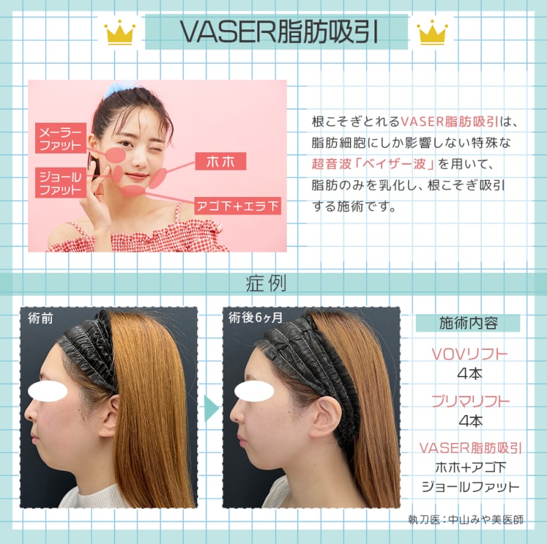 より小顔になりたいなら脂肪吸引が◎