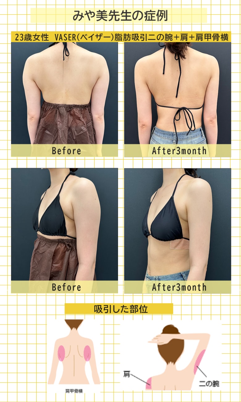 甲府院院長★みや美先生の脂肪吸引症例はこちら
