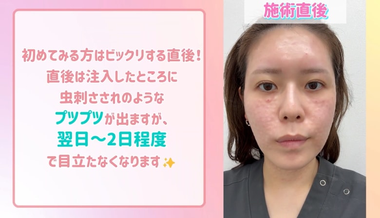 施術直後～1週間後の経過