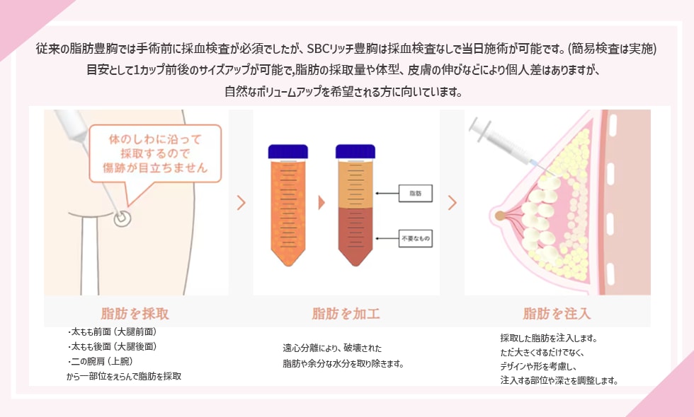 SBCリッチ豊胸