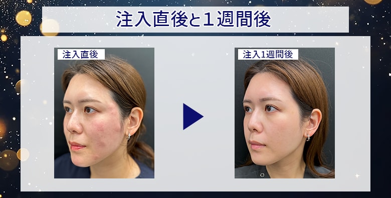 注入直後と１週間後を比較