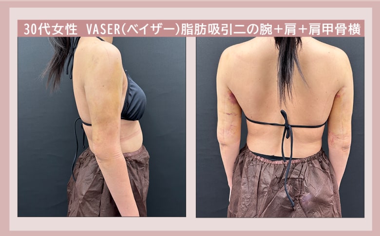 術後3日目~1カ月のダウンタイムを紹介