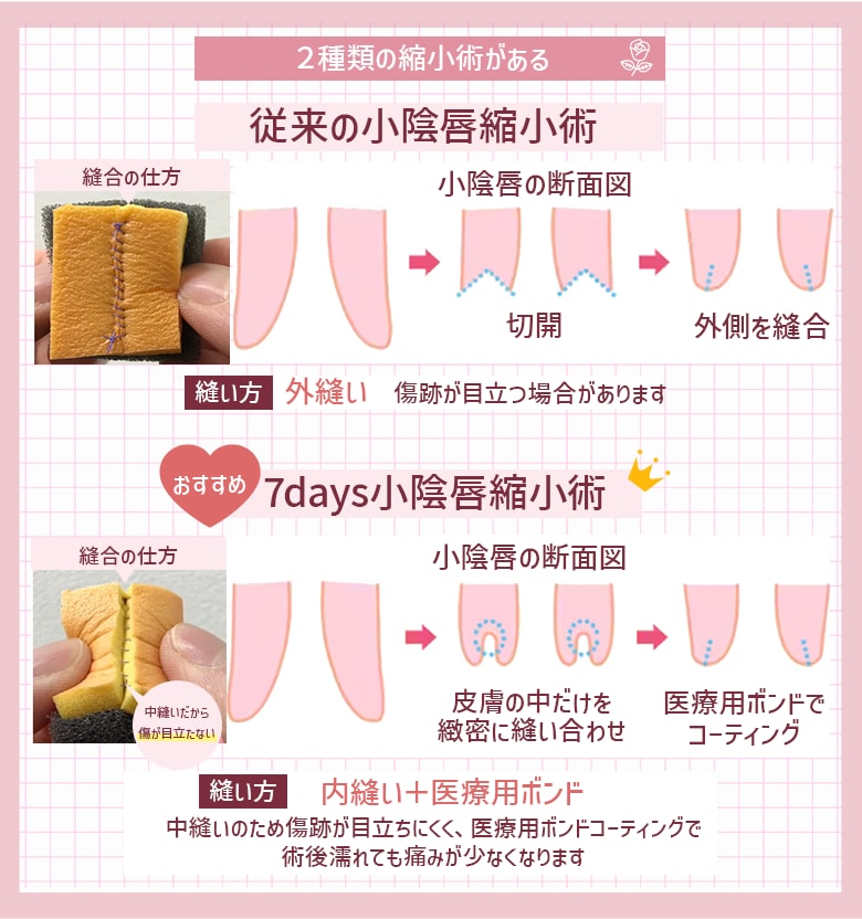 小陰唇縮小術は2つある！