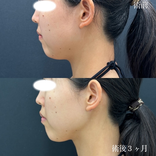 アゴ下＋エラ下