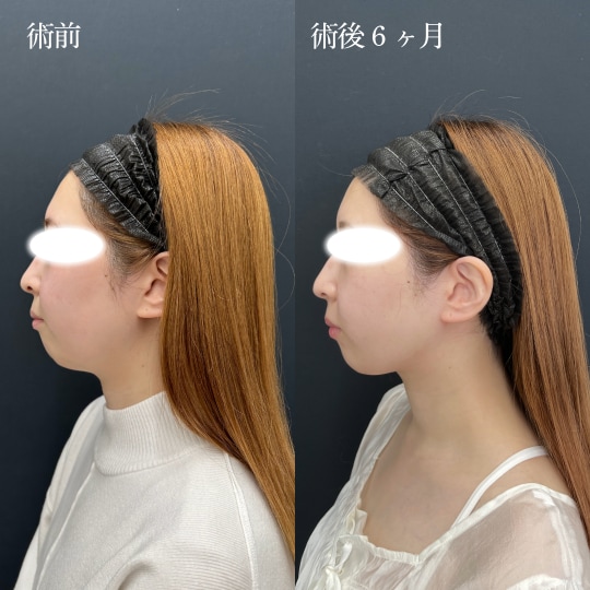 ホホ＋アゴ下＋エラ下＋ジョール