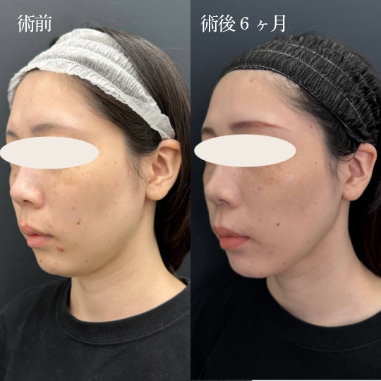 アゴ下＋エラ下