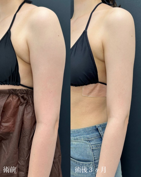 二の腕＋肩＋肩甲骨横＋胸上部（脇肉、副乳）