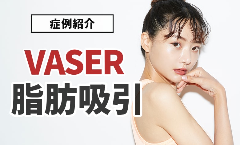 【症例紹介】脂肪吸引するならSBC甲府院!!